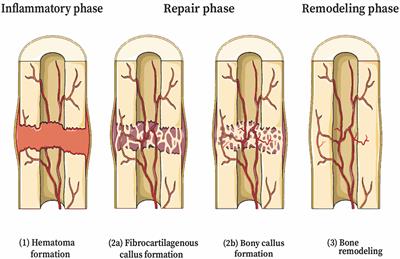 Nanomaterial Nitric Oxide Delivery in Traumatic Orthopedic Regenerative Medicine